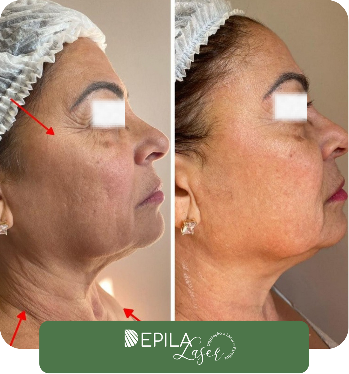 Ultrassom microfocado (1) (1).pdf (1)