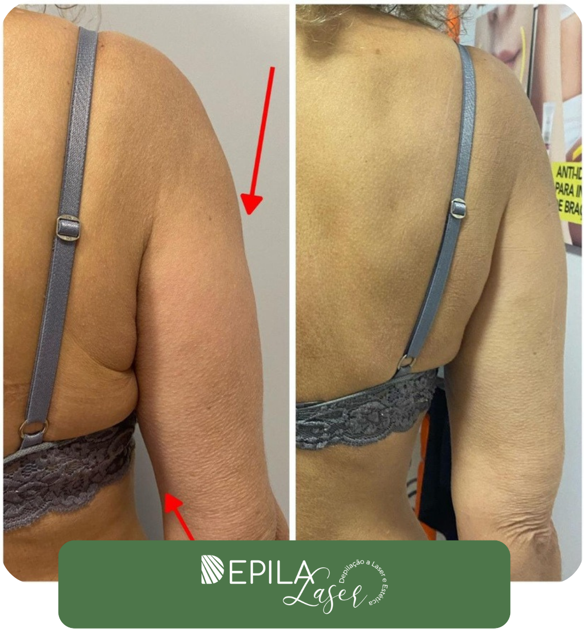 Ultrassom microfocado (1) (1).pdf (2)