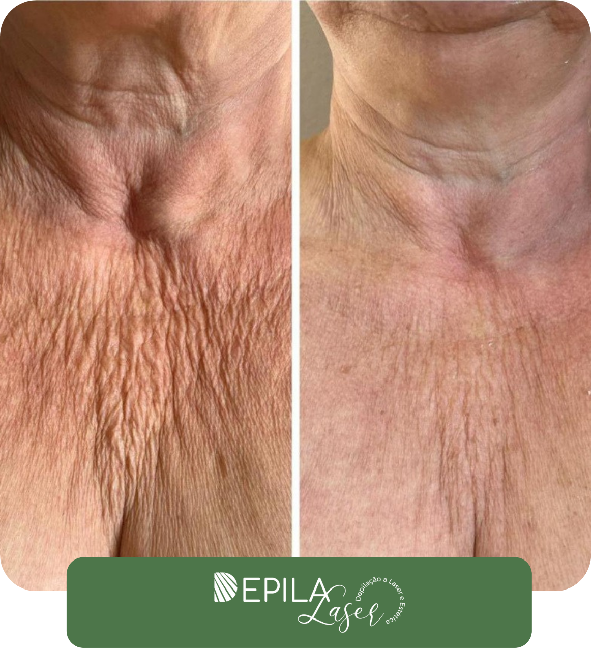 Ultrassom microfocado (1) (1).pdf (3)