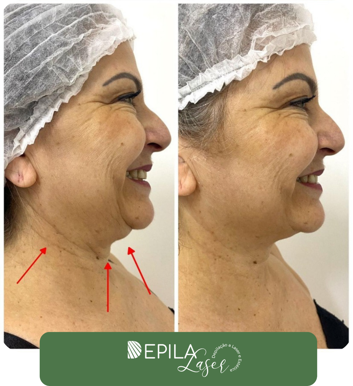 Ultrassom microfocado (1) (1).pdf (4)