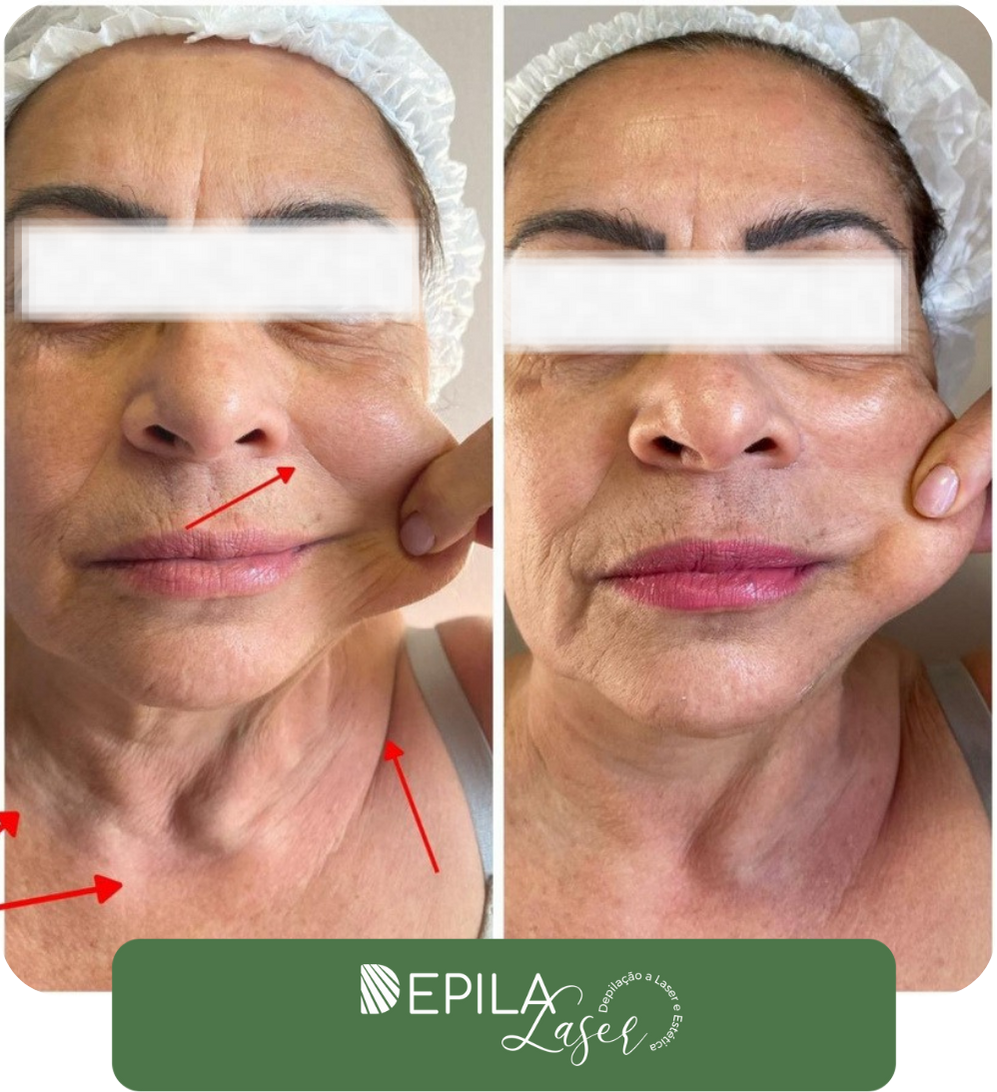 Ultrassom microfocado (1) (1).pdf